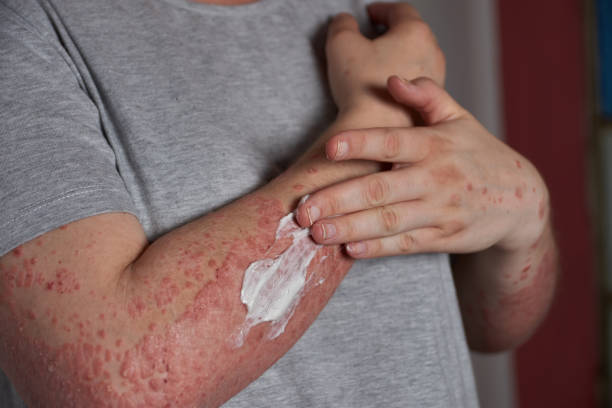 銀屑病的4類治療方式和用藥類型，你都清楚嗎？