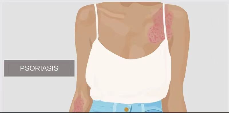 銀屑病的體征和癥狀是什么？及其治療方法