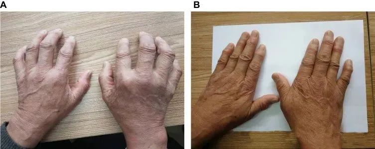 一名68歲男性被診斷患有類風(fēng)濕性關(guān)節(jié)炎治療前后對(duì)比