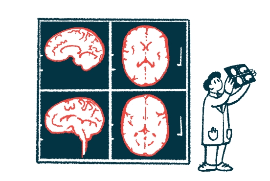 MRI精準給藥系統(tǒng)用于干細胞治療帕金森癥的臨床試驗 MRI精準給藥系統(tǒng)用于干細胞治療帕金森癥的臨床試驗