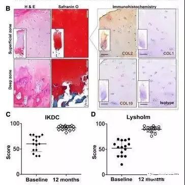 干細(xì)胞治療膝骨關(guān)節(jié)炎臨床案例