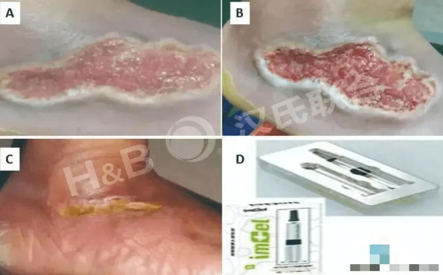 糖尿病足潰瘍患者使用胎盤(pán)衍生間充質(zhì)干細(xì)胞水凝膠進(jìn)行三周局部治療：病例報(bào)告。