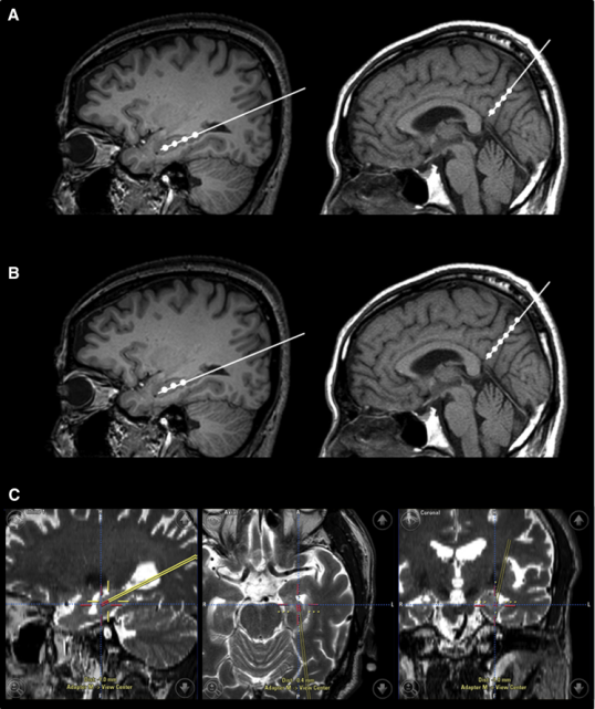 干細胞立體定向注射患者的右海馬體和右前丘盤