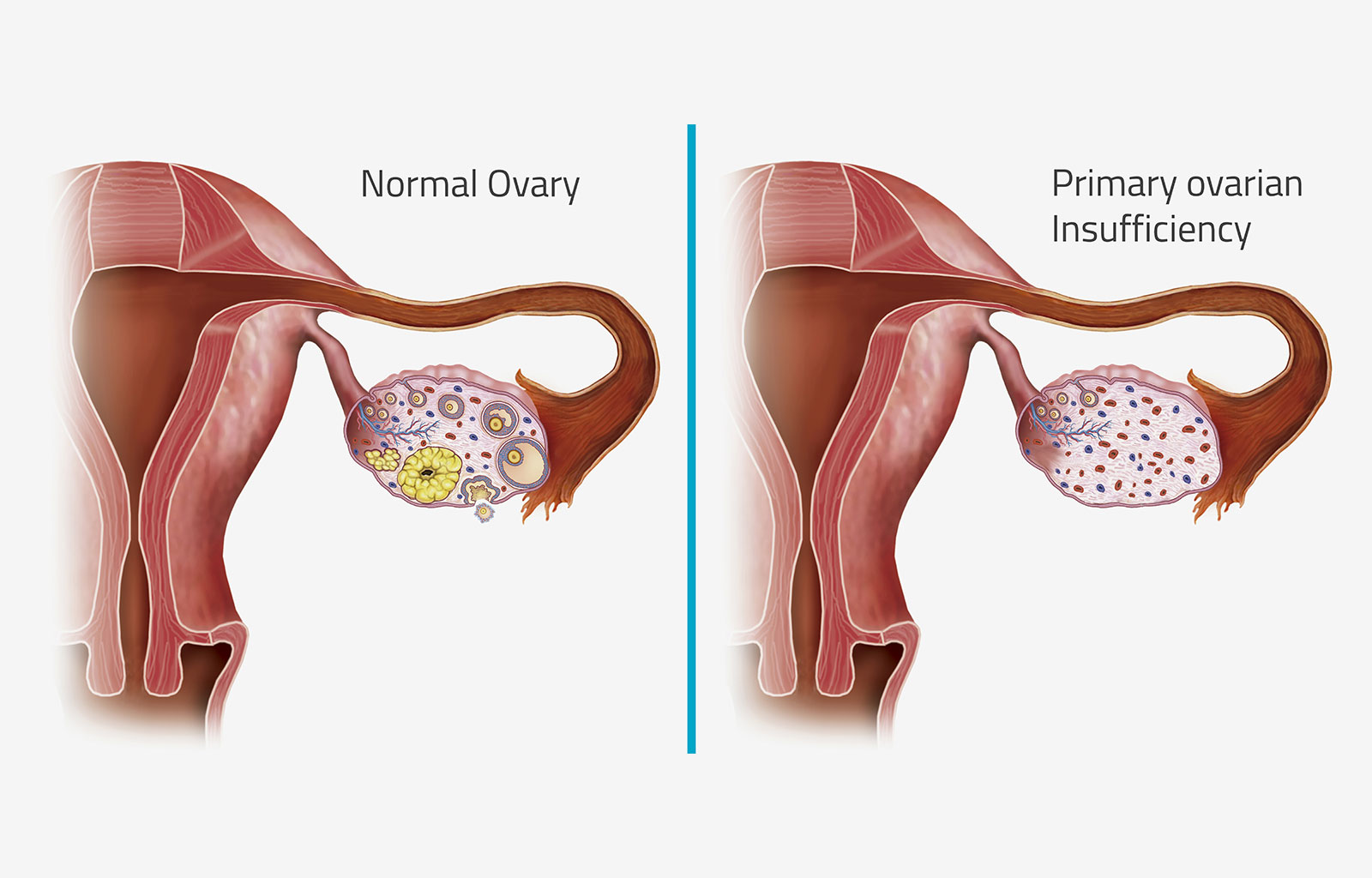 正常卵巢與患上卵巢早衰之后的卵巢對(duì)比