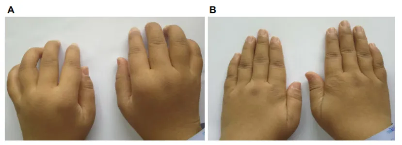 33歲女性，患病4年，治療前后對比