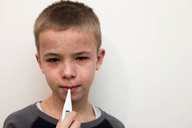 兒童狼瘡性腎炎-癥狀、原因和治療方法