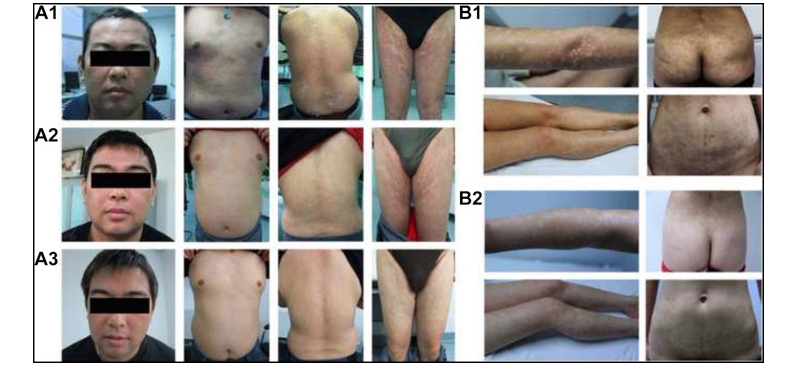 兩例尋常型銀屑病患者通過(guò)臍帶間充質(zhì)干細(xì)胞（UC-MSCs）治療，兩例患者均在4至5年內(nèi)未復(fù)發(fā)。