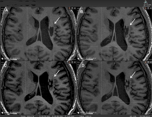 圖2：腔內(nèi)組織生長(zhǎng)的縱向MRI示例。