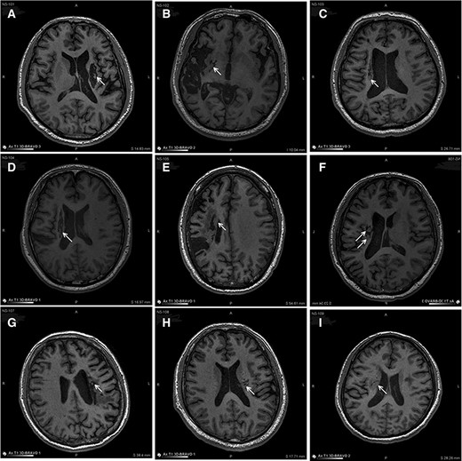 圖3：NSI-566移植后最新隨訪時(shí)梗塞部位的MRI。