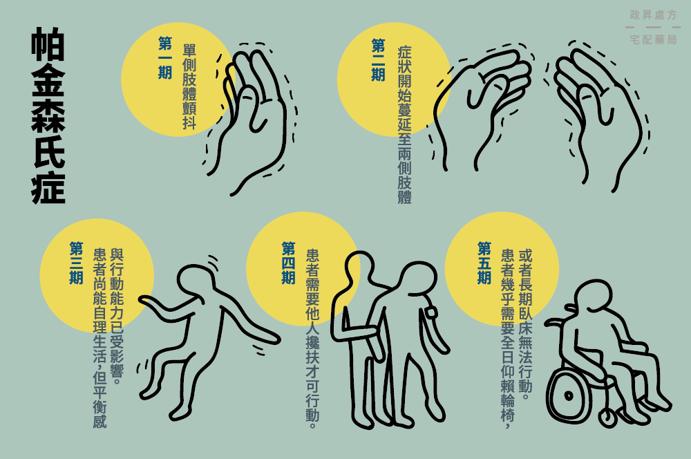 帕金森病的5個(gè)階段 帕金森病的5個(gè)階段