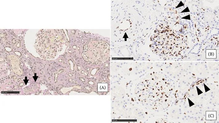 在住院第31天進(jìn)行的腎活檢結(jié)果 在住院第31天進(jìn)行的腎活檢結(jié)果