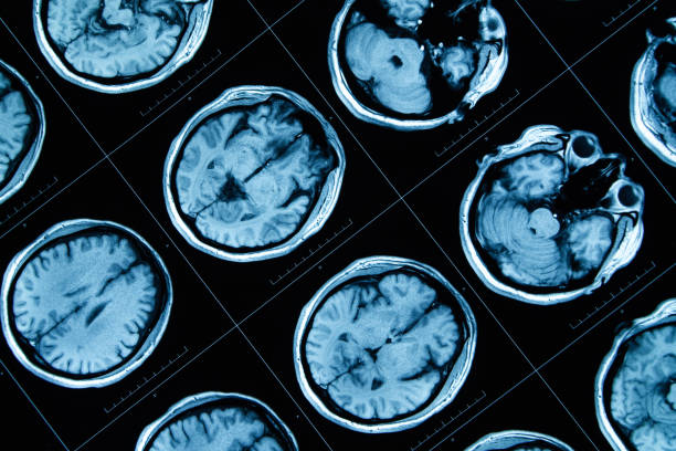 8.干細胞治療神經(jīng)系統(tǒng)疾病