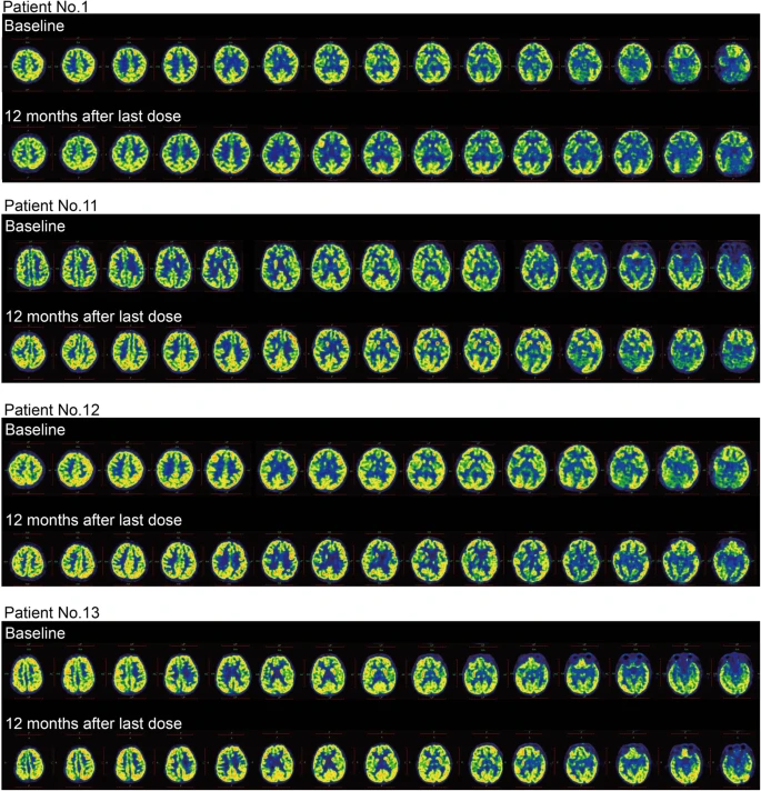 圖3：干預(yù)后腦代謝變化。