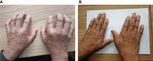 （圖1A）表現(xiàn)為雙手不能伸直。

（圖1B）治療3年后，停用抗風(fēng)濕藥物5年，雙手伸展自如，關(guān)節(jié)周圍風(fēng)濕結(jié)節(jié)逐漸變軟、消退。