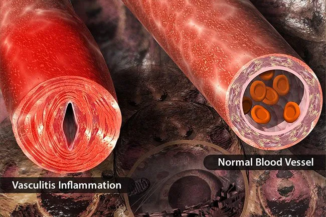 ANCA血管炎 ANCA血管炎