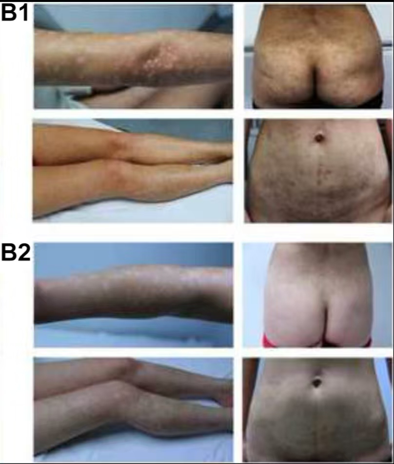 （圖B1）患者入院后體檢發(fā)現(xiàn)，患者全身遍布橙紅色斑塊，上面覆有銀色鱗屑

（圖B2）治療初期，我院給予患者3次臍帶間充質(zhì)干細(xì)胞，連續(xù)3周回輸，患者全身表面逐漸恢復(fù)光滑