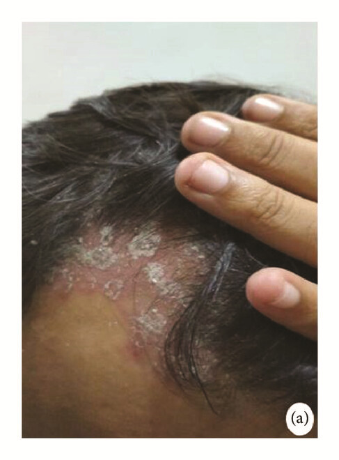 骨髓間充質(zhì)干細(xì)胞 治療前，患者頭皮上出現(xiàn)大量紅斑，并附著銀色鱗片（a）。
