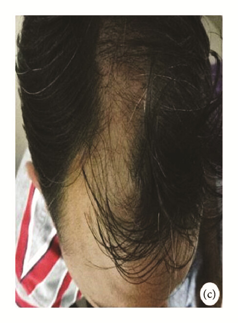 局部應(yīng)用骨髓間充質(zhì)干細(xì)胞一個(gè)月后，銀屑病消退，炎性紅斑完全清除（c）。