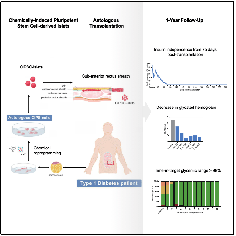 圖1:基于CiPS細(xì)胞治療1型糖尿病的臨床研究的示意圖和治療效果 圖1:基于CiPS細(xì)胞治療1型糖尿病的臨床研究的示意圖和治療效果
