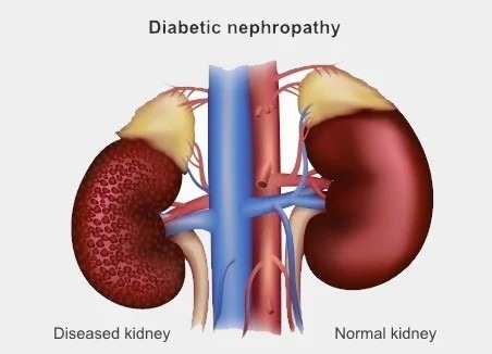 糖尿病腎病如何治療？干細胞療法為什么讓糖尿病腎病患者驚嘆？