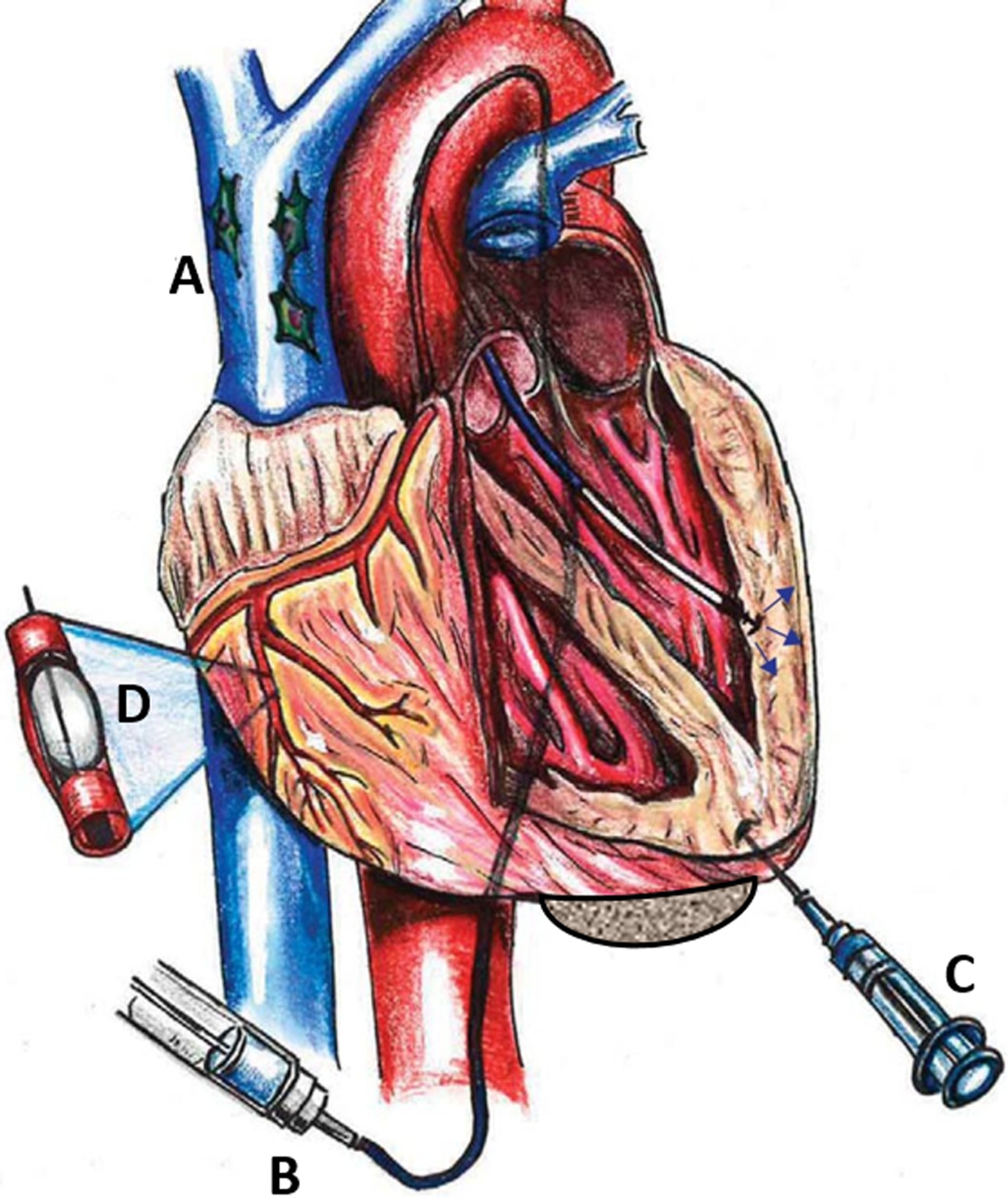 圖1:MSC通過(guò)系統(tǒng) (Sys) 和局部 (Loc) 途徑進(jìn)入心臟。