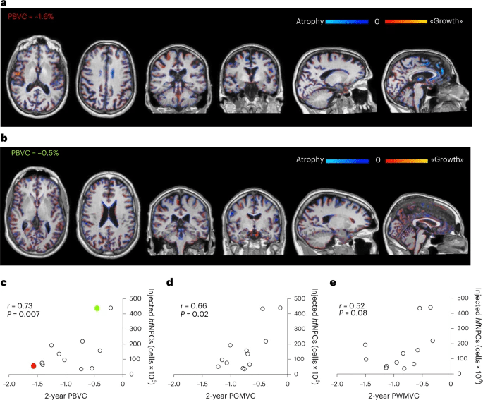 圖5：注射的神經(jīng)干細胞數(shù)量與腦容量損失呈反比