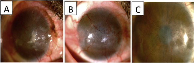 右眼 眼表鱗狀腫瘤照片。