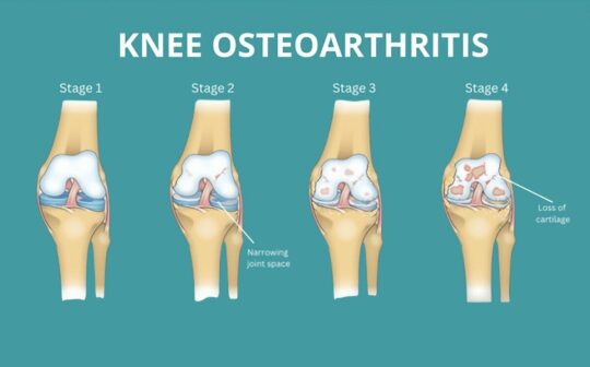干細(xì)胞治療膝骨關(guān)節(jié)炎：患者臨床癥狀顯著改善，減少炎癥，消除疼痛