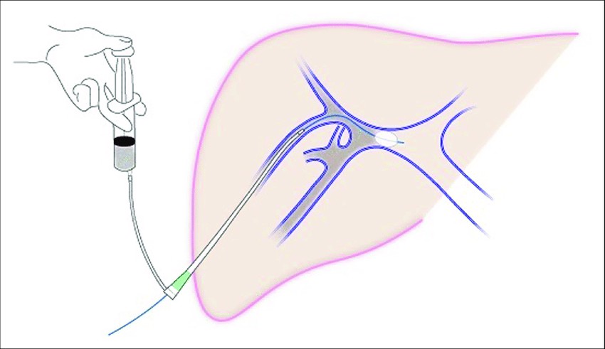 肝門靜脈輸注 肝門靜脈輸注