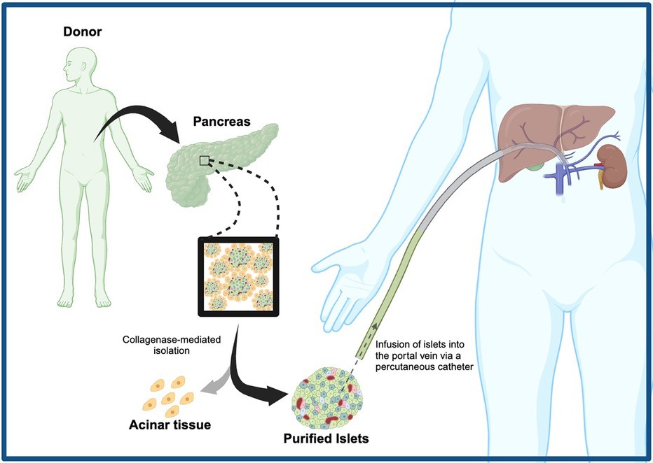 胰腺組織局部輸注 胰腺組織局部輸注