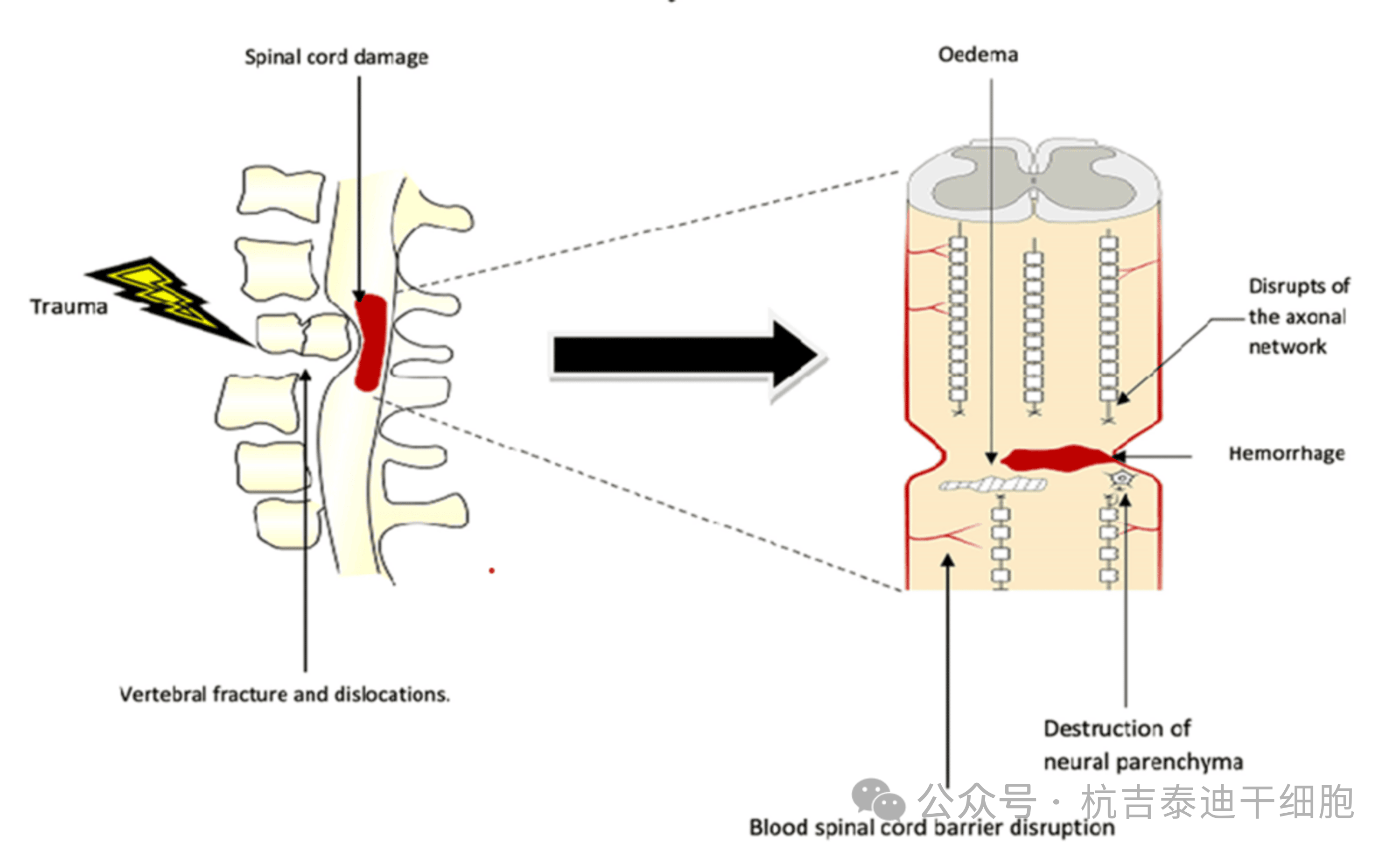 圖1：原發(fā)性病變，該圖顯示了創(chuàng)傷的直接影響，包括椎骨骨折、脫位和脊髓損傷導(dǎo)致軸突斷裂、水腫、出血和神經(jīng)實(shí)質(zhì)破壞