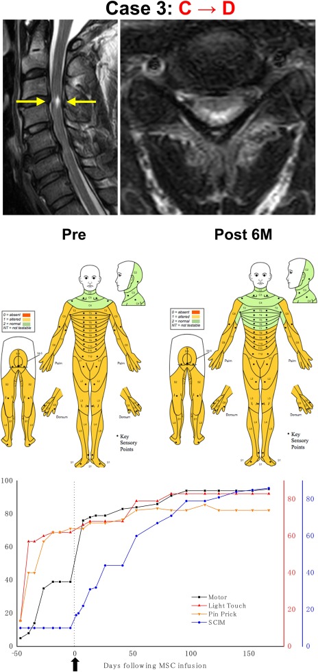 干細(xì)胞治療后患者的恢復(fù)狀態(tài)圖