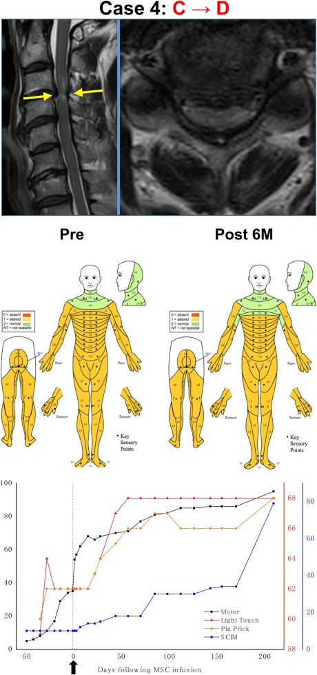 干細(xì)胞治療后患者的恢復(fù)狀態(tài)圖