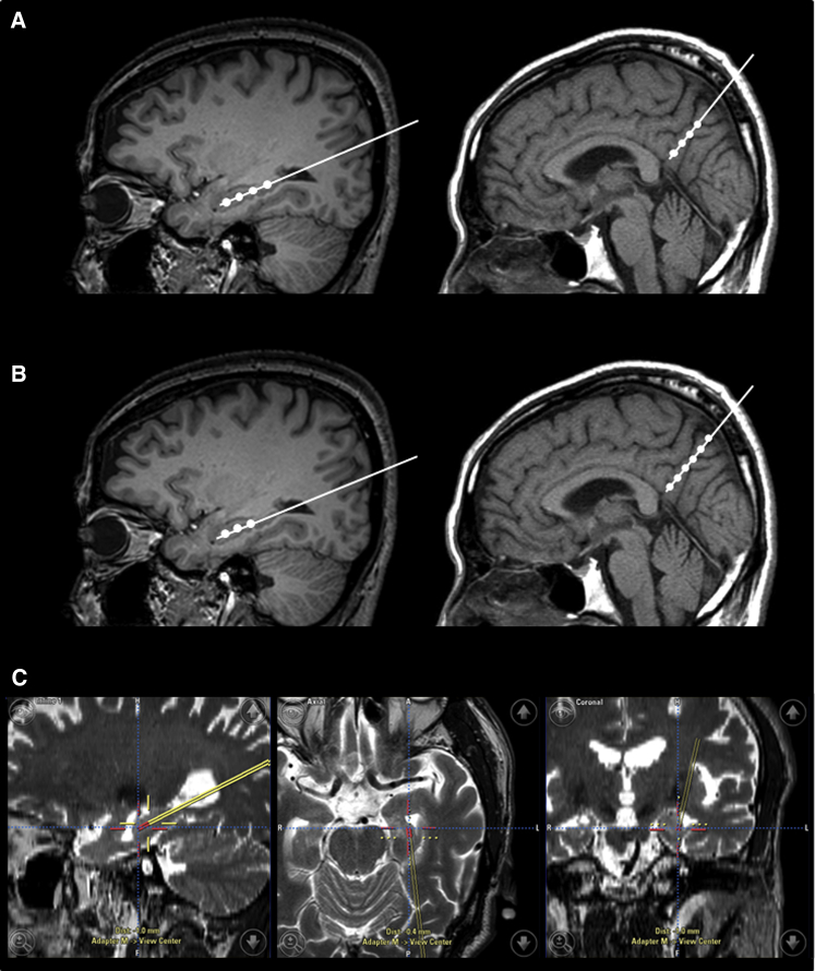 臍帶間充質(zhì)干細(xì)胞的立體定向給藥 臍帶間充質(zhì)干細(xì)胞的立體定向給藥
