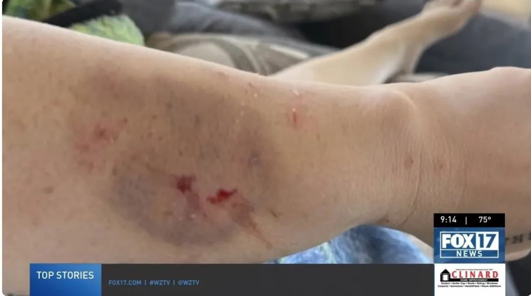 在接受干細(xì)胞治療前表現(xiàn)出嚴(yán)重的自閉癥癥狀，甚至曾咬傷母親安吉拉，留下了永久的疤痕