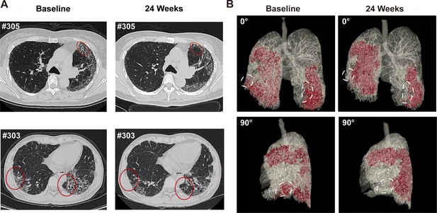 圖4：REGEND001治療前后的代表性肺部CT圖像。