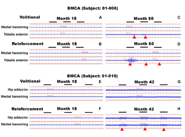 BMCA 識別自愿或強化動作引發(fā)的 EMG 活動