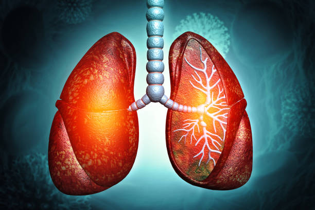 間充質(zhì)干細(xì)胞治療4大類肺部疾病的臨床試驗(yàn)進(jìn)展及挑戰(zhàn) 間充質(zhì)干細(xì)胞治療4大類肺部疾病的臨床試驗(yàn)進(jìn)展及挑戰(zhàn)