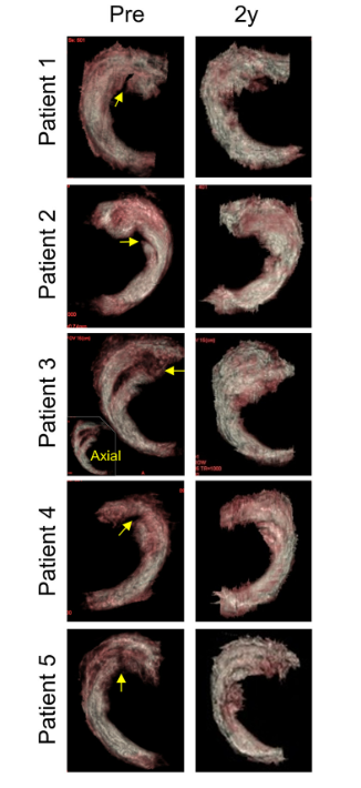 移植滑膜間充質(zhì)干細(xì)胞修復(fù)前后的3D MRI圖像