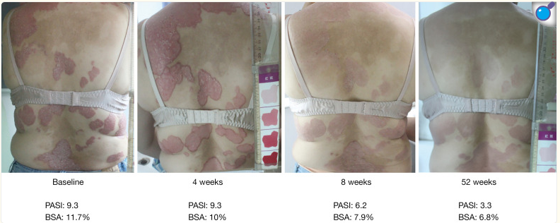 受試者治療前后的代表性皮膚圖像。