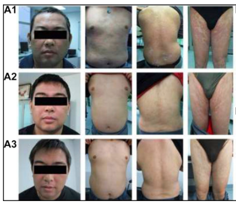 患者一治療前后的對(duì)比圖