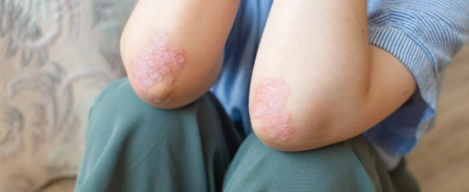 干細(xì)胞治療銀屑病：如何實(shí)現(xiàn)從短期銀屑病面積減少到長(zhǎng)期皮膚恢復(fù)正常？