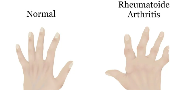 干細(xì)胞治療類風(fēng)濕關(guān)節(jié)炎：如何實(shí)現(xiàn)從短期關(guān)節(jié)功能改善到長期的生活質(zhì)量提升？