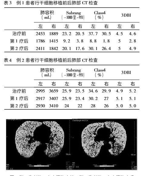 干細(xì)胞移植前后的肺部CT檢查對比