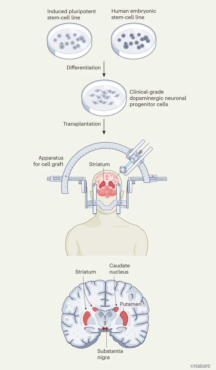 圖1：帕金森病的干細(xì)胞療法。