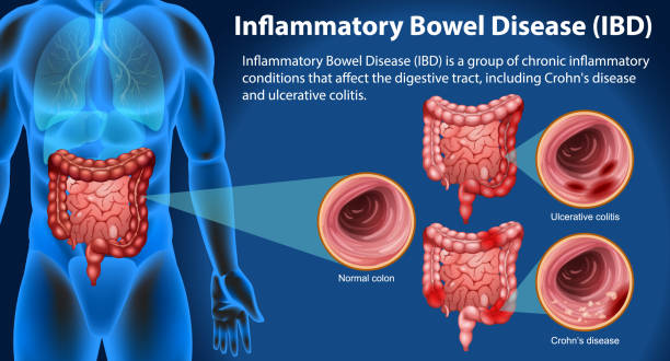 干細胞終結(jié)炎癥性腸??？8大問題解答揭秘細胞療法如何改寫治療規(guī)則