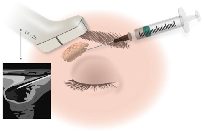 圖1：在超聲引導(dǎo)下向淚腺注射藥物。
