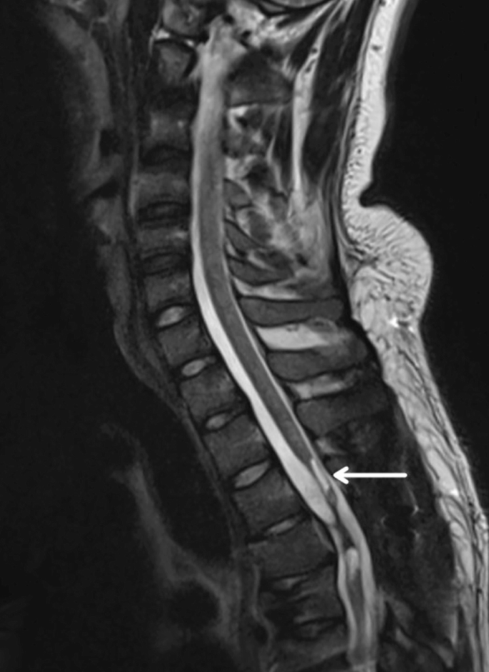 圖2：X射線圖像顯示慢性期脊髓損傷，通常以囊腫形成為特征，如白色箭頭所示