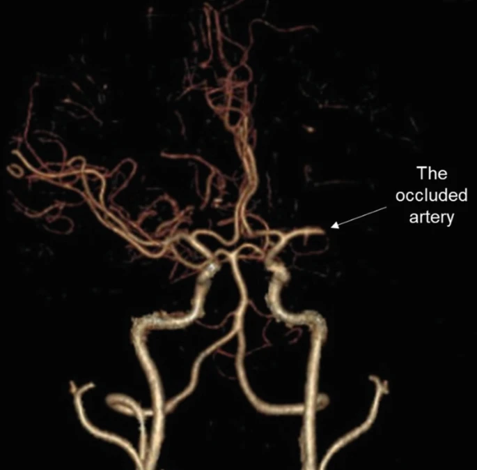 圖1:動(dòng)脈閉塞導(dǎo)致的缺血性中風(fēng) 圖1:動(dòng)脈閉塞導(dǎo)致的缺血性中風(fēng)