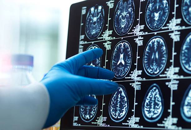 神經(jīng)干細胞移植十大常見問題解答:從原理到術后護理全知道 神經(jīng)干細胞移植十大常見問題解答:從原理到術后護理全知道